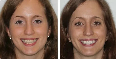 🔥Ends Tonight: Get 60% OFF Before It’s Gone!🎁 Fluoride-Free Hydroxyapatite Toothpaste – Gentle Whitening & Enamel Strength for Sensitive Teeth